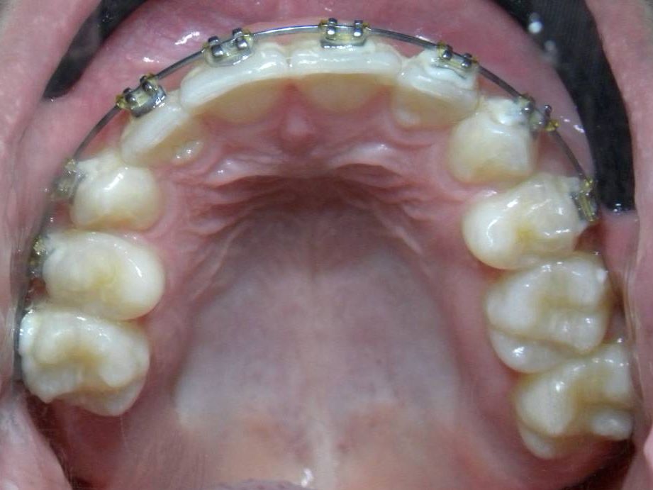 Oclusal Superior