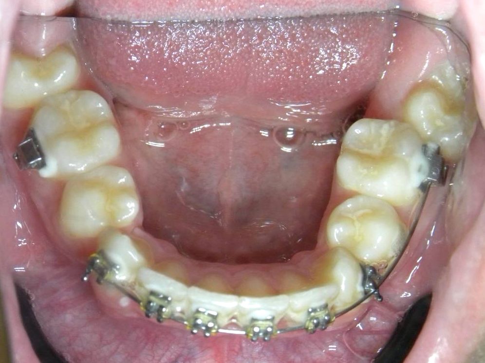 Oclusal Inferior