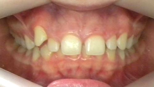 Frontal (Oclusión)