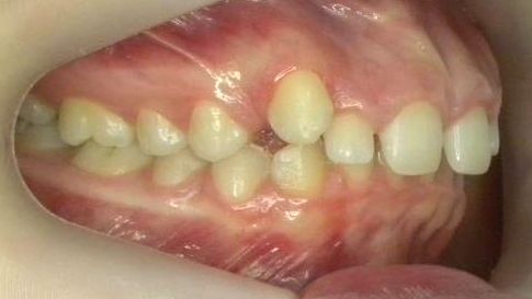 Lateral Derecha