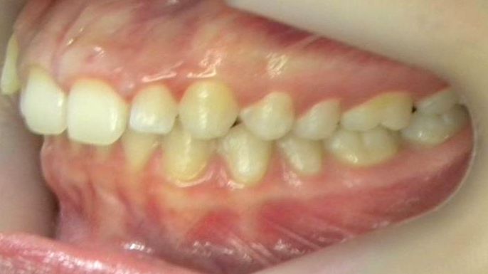 Lateral Izquierda