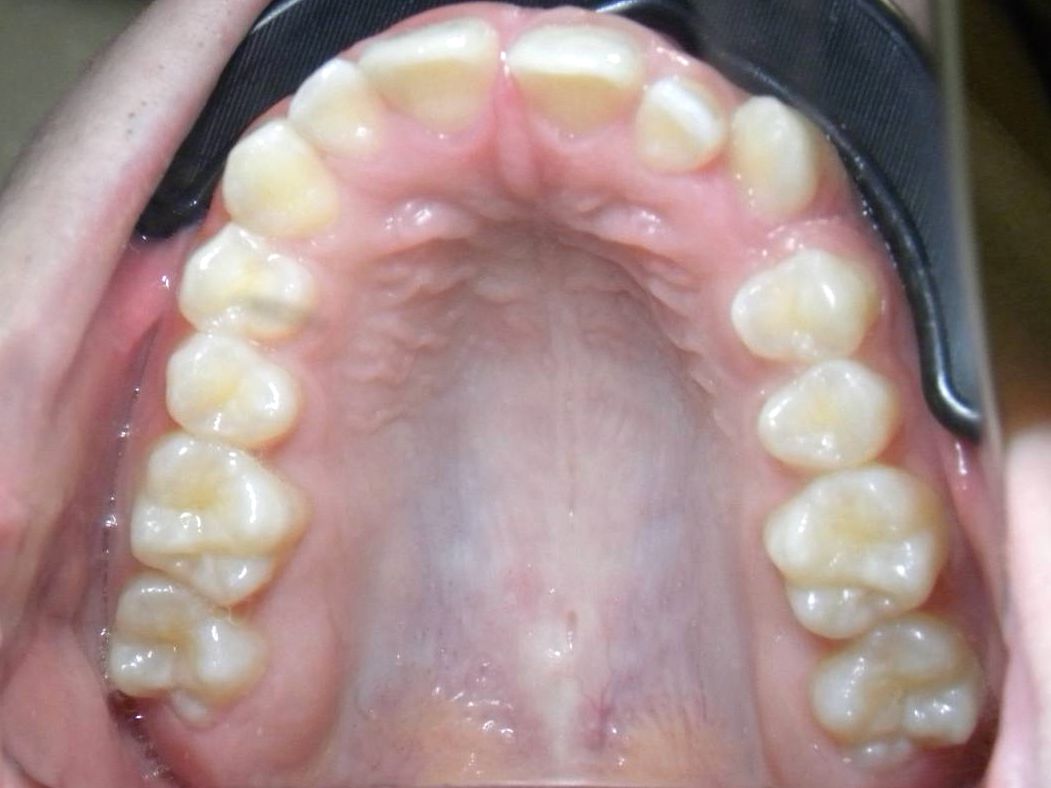 Oclusal Superior