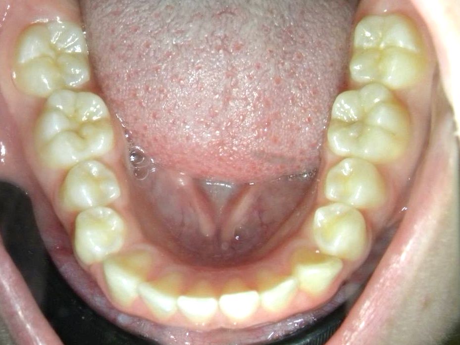 Oclusal Inferior