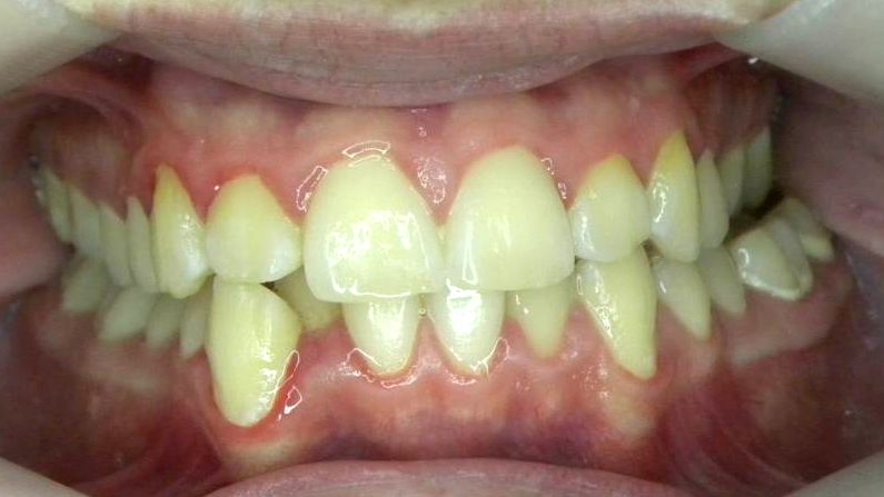 Frontal (Oclusión)