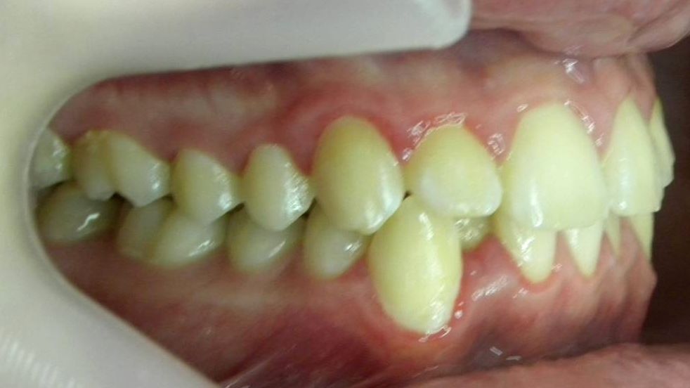 Lateral Derecha