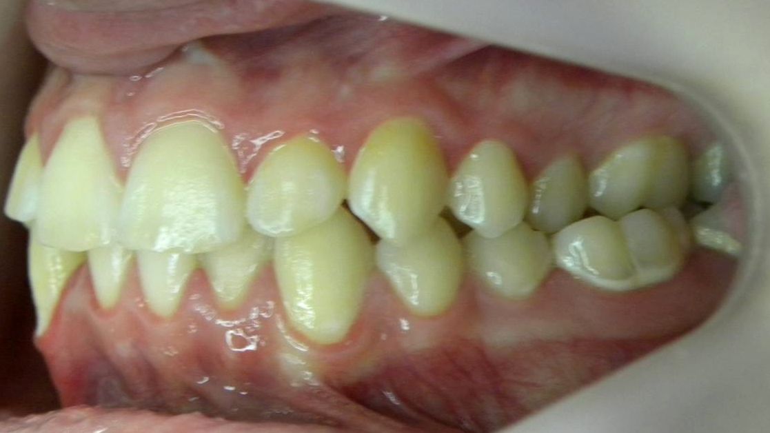 Lateral Izquierda