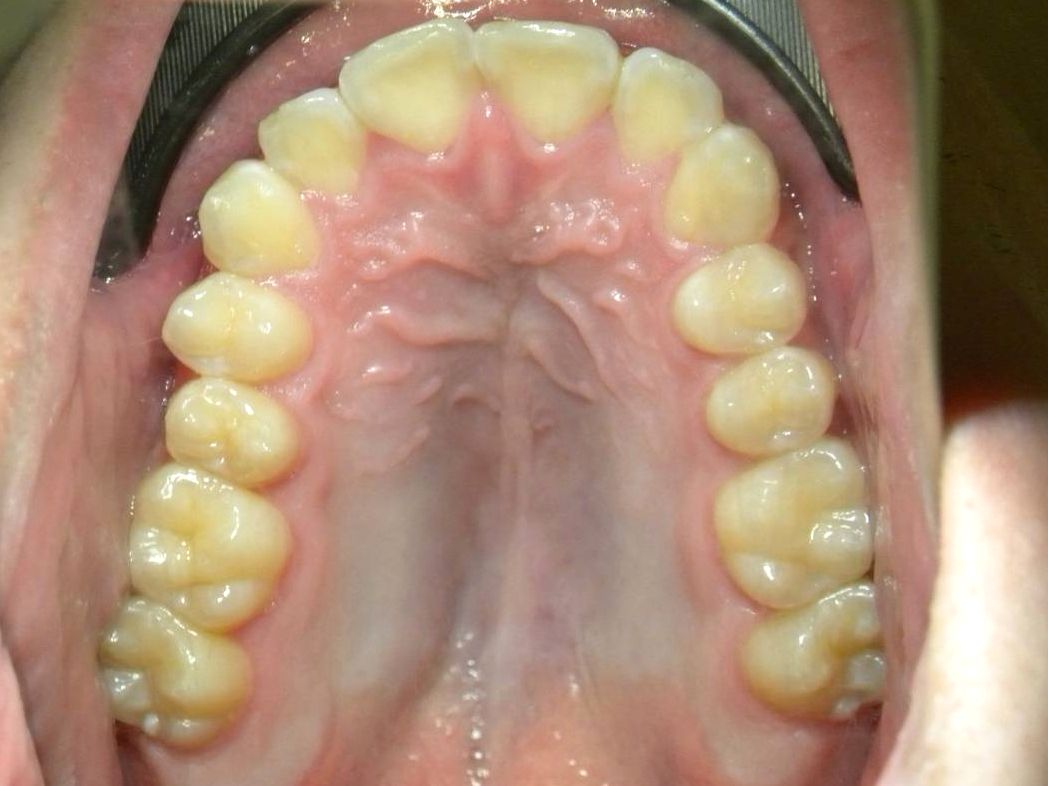 Oclusal Superior