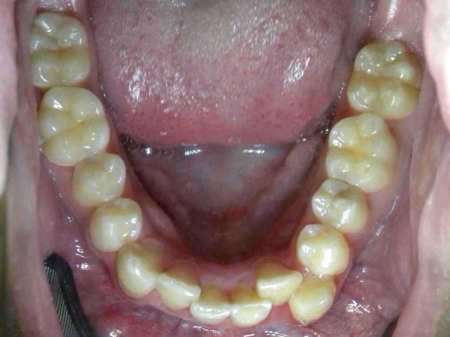 Oclusal Inferior