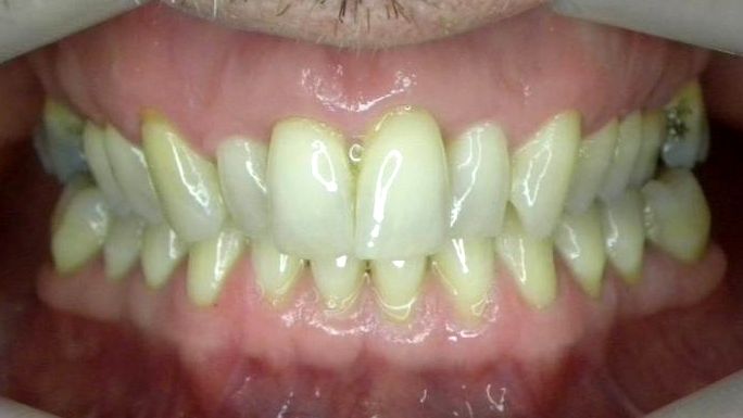 Frontal (Oclusión)