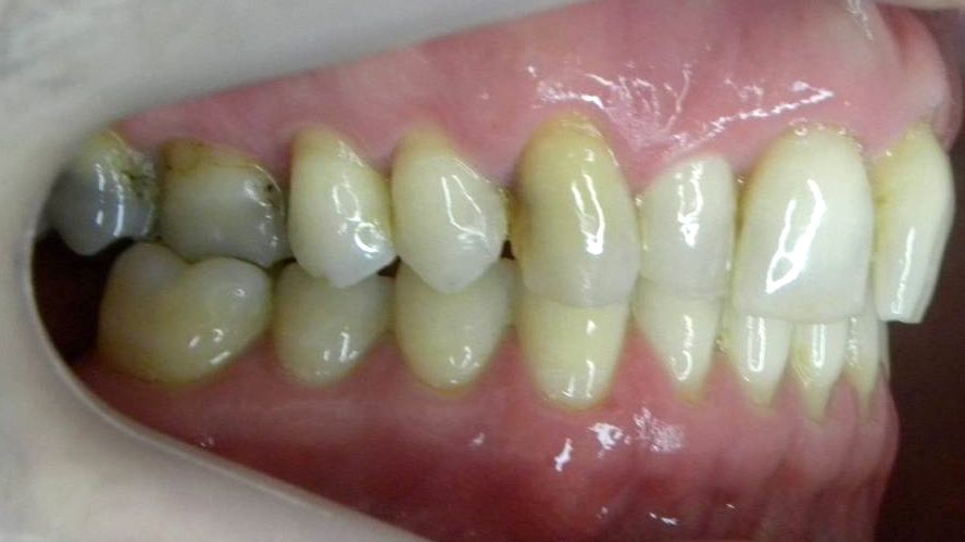 Lateral Derecha