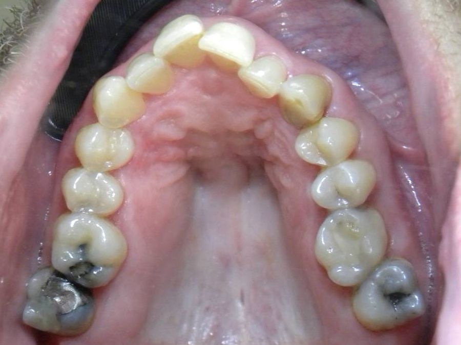 Oclusal Superior