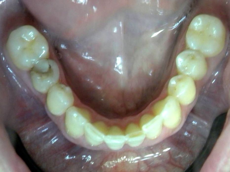 Oclusal Inferior