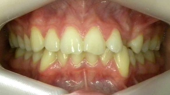 Frontal (Oclusión)
