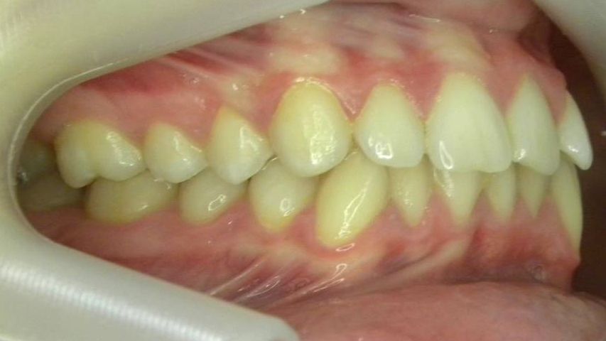 Lateral Derecha