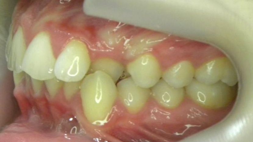 Lateral Izquierda
