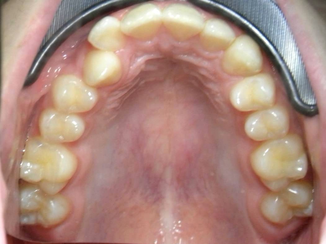 Oclusal Superior