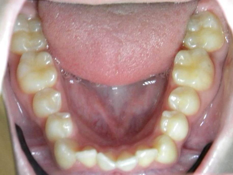 Oclusal Inferior