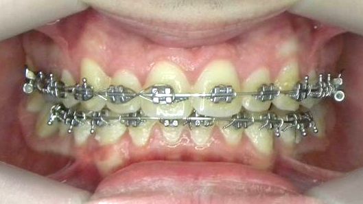 Frontal (Oclusión)
