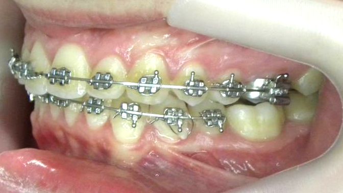 Lateral Izquierda