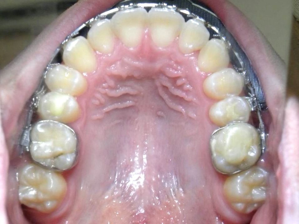 Oclusal Superior