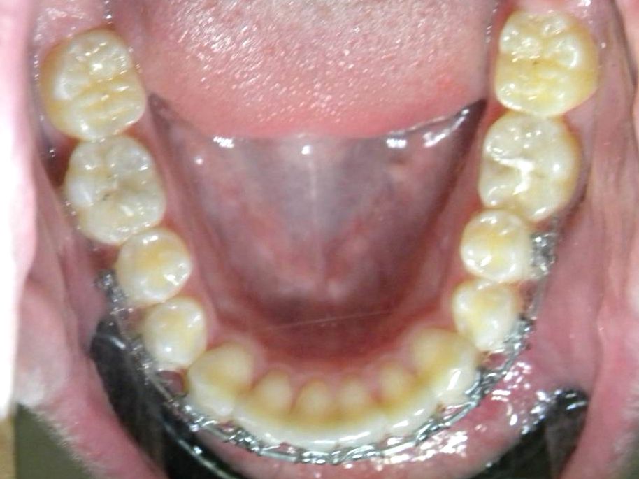 Oclusal Inferior
