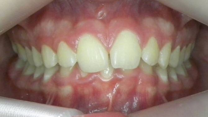 Frontal (Oclusión)
