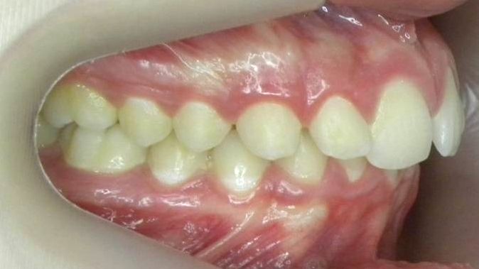 Lateral Derecha