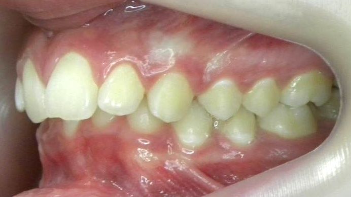 Lateral Izquierda
