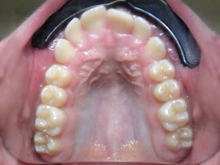 Oclusal Superior
