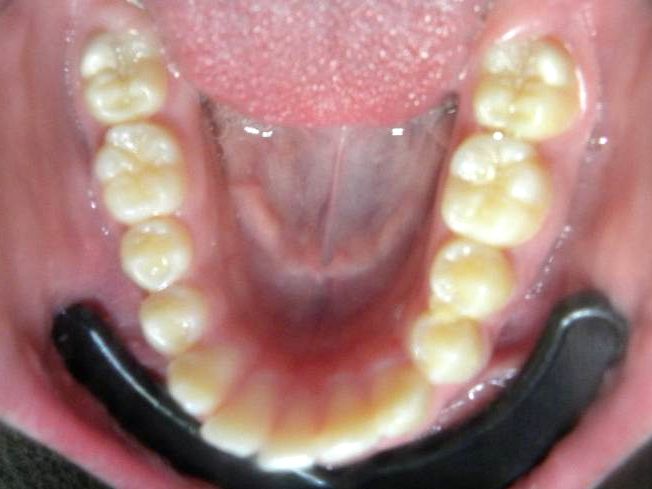 Oclusal Inferior