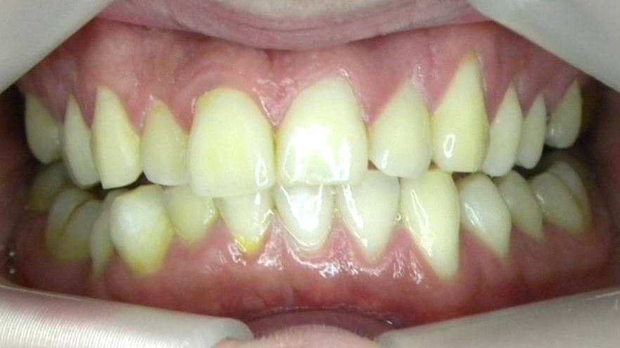 Frontal (Oclusión)
