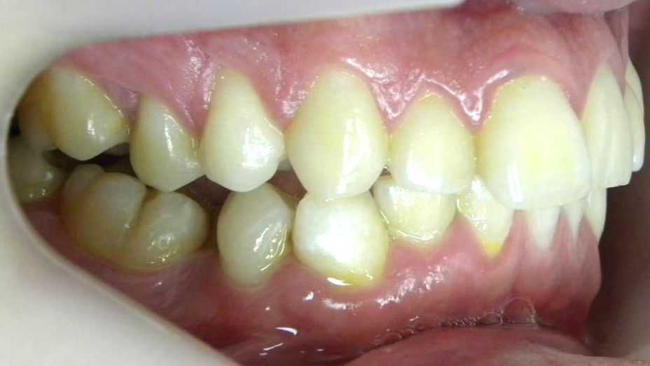 Lateral Derecha