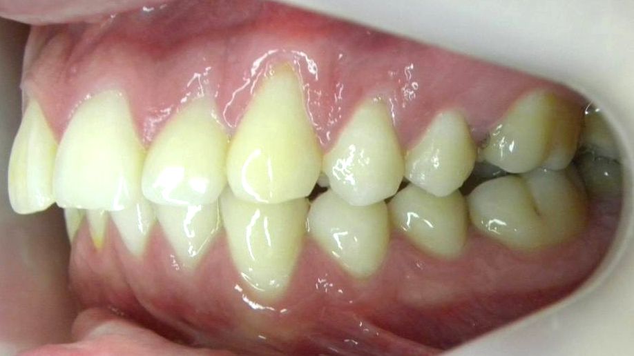 Lateral Izquierda