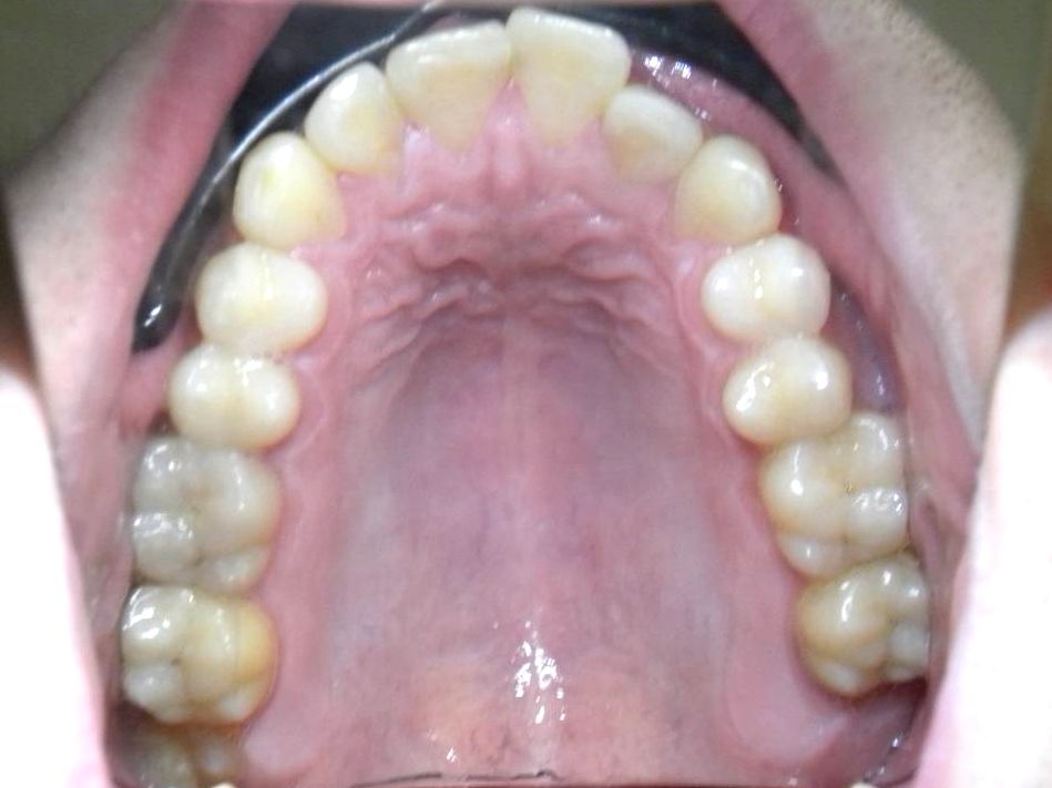 Oclusal Superior