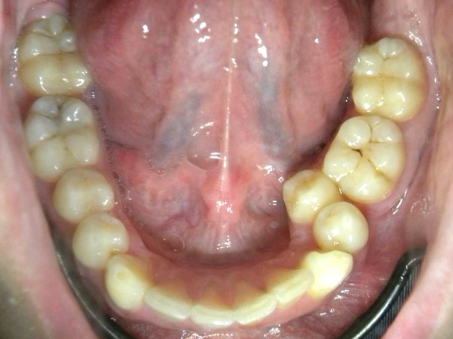 Oclusal Inferior