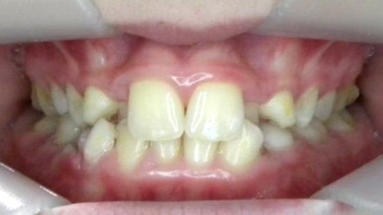 Frontal (Oclusión)