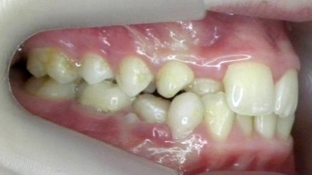 Lateral Derecha