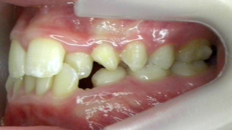 Lateral Izquierda