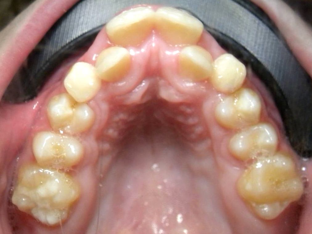 Oclusal Superior