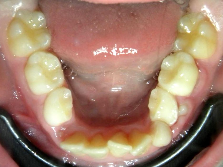 Oclusal Inferior