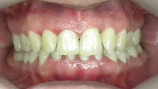 Frontal (Oclusión)