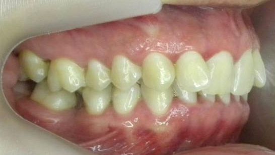 Lateral Derecha