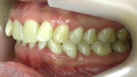 Lateral Izquierda