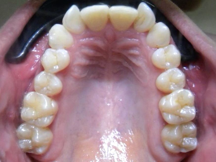 Oclusal Superior