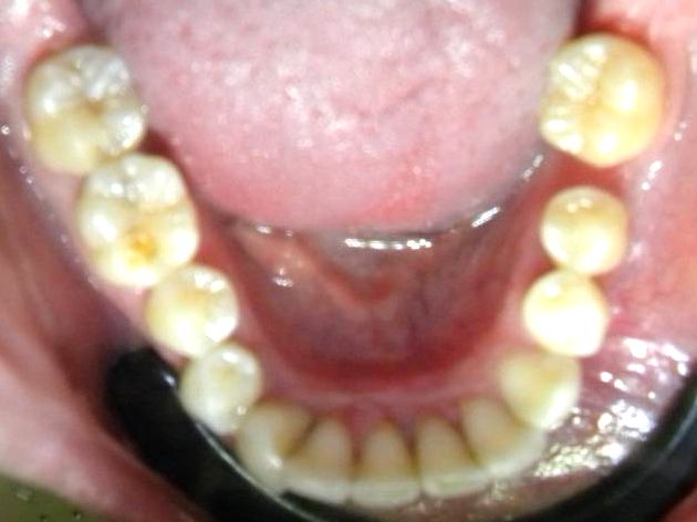 Oclusal Inferior