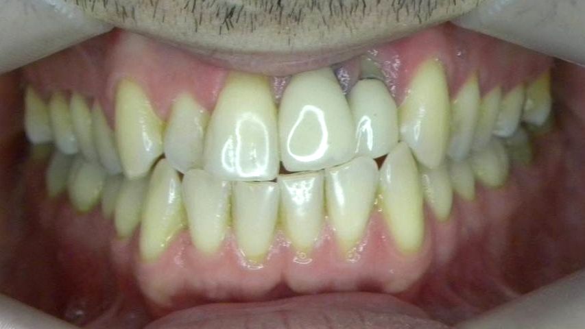 Frontal (Oclusión)