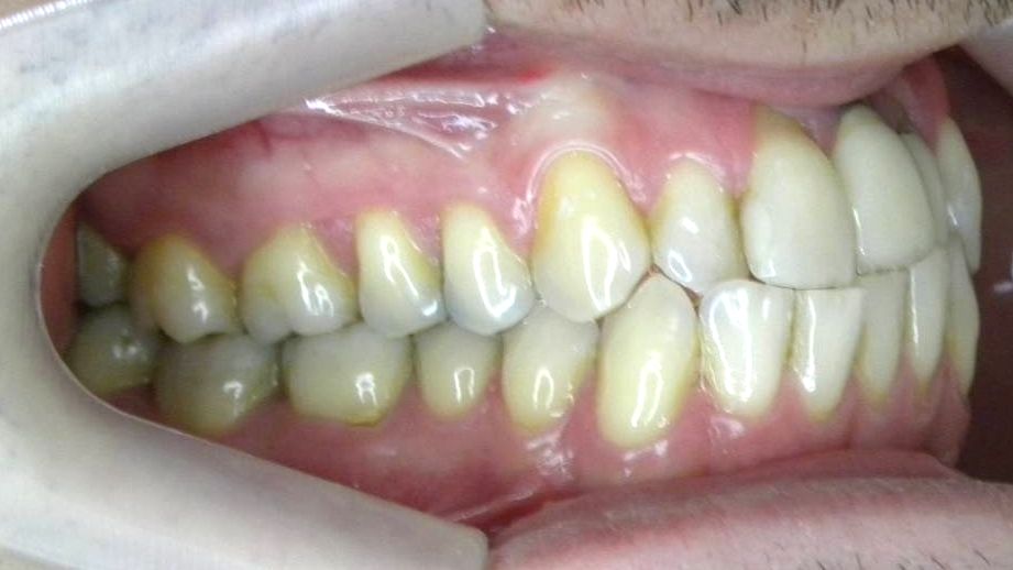 Lateral Derecha