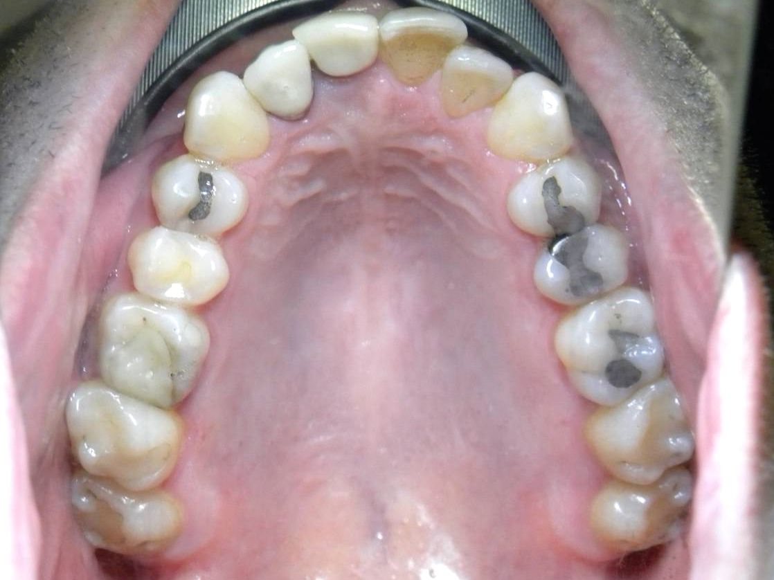 Oclusal Superior