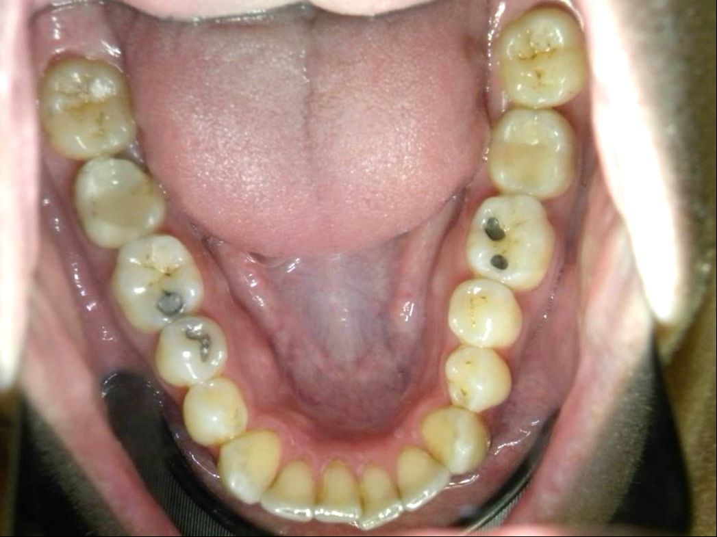 Oclusal Inferior