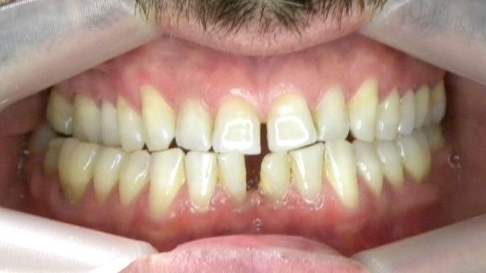 Frontal (Oclusión)